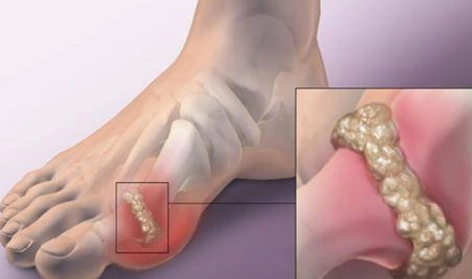 治疗痛风医院费用清单